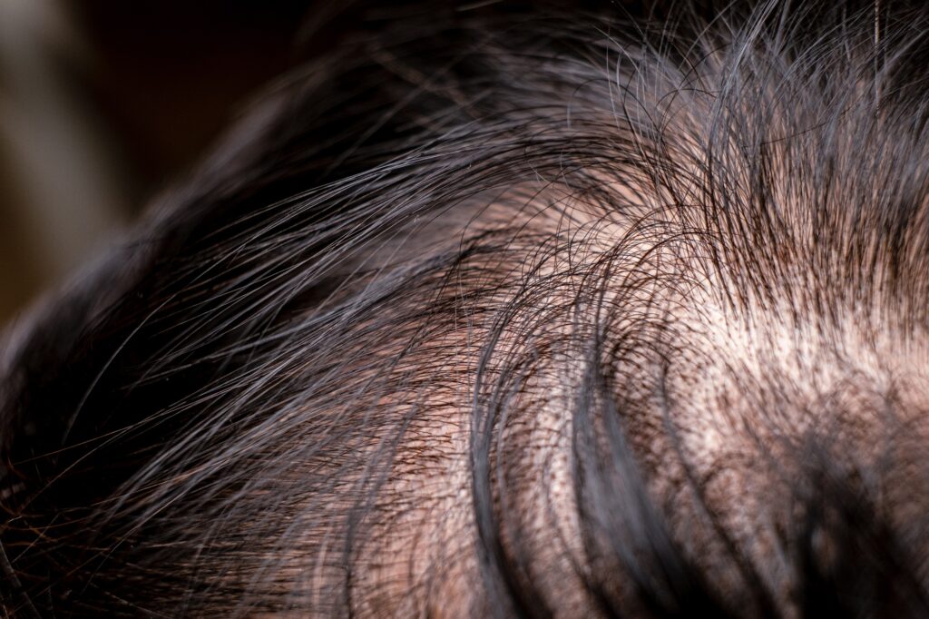 hair loss and thin.
