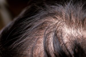 hair loss and thin.